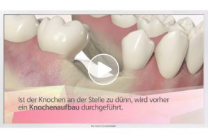 Patientenaufklärungs-Film zum Thema "Zahn-Implantate" von TV-Wartezimmer.