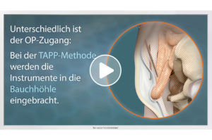 Patientenaufklärungs-Film zum Thema "endoskopische Leistenbruch-OP" von TV-Wartezimmer.