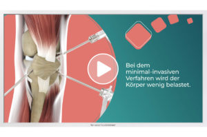 Patientenaufklärungs-Film zum Thema "Arthroskopie bei Kniebeschwerden" von TVWartezimmer.
